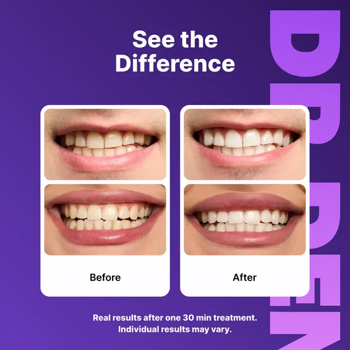 7 Purple Strips = 21 Whiter Smiles – No Pain, No Peroxide, Just Results